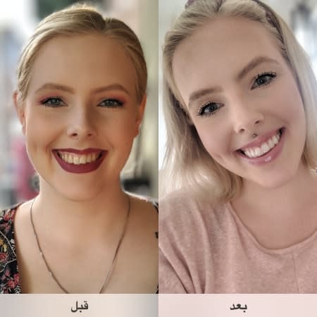 How does Invisalign clear aligners work? Before and after