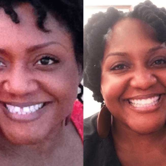 Before and after image of Invisalign Treatment
