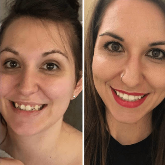 Before and after image of Invisalign Treatment